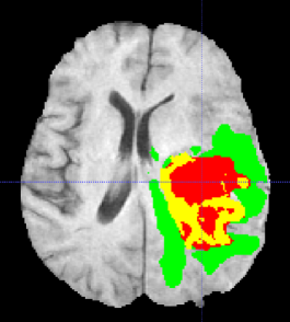 mri scan brain 3d